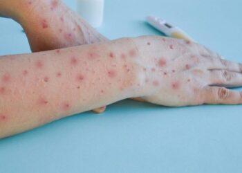 Ministério da Saúde se prepara para enfrentar aumento de casos de mpox no Brasil