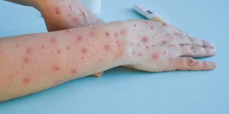 Ministério da Saúde se prepara para enfrentar aumento de casos de mpox no Brasil