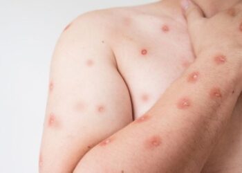 Mato Grosso do Sul Confirma Primeiro Caso de Mpox em Corumbá e Alerta População