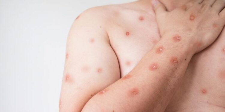 Mato Grosso do Sul Confirma Primeiro Caso de Mpox em Corumbá e Alerta População