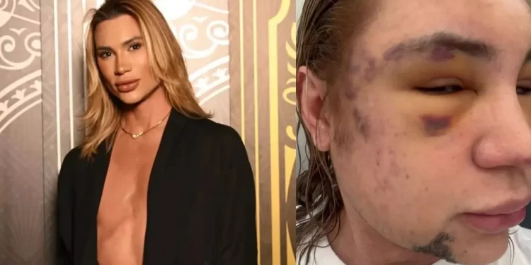 Influenciador Junior Dutra morre após procedimento estético malsucedido